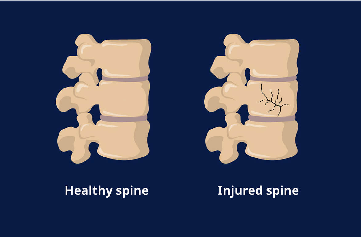 An illustration of a healthy spine and an injured spine